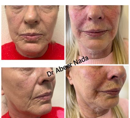 Cheeks and Nasolabial Folds Filler