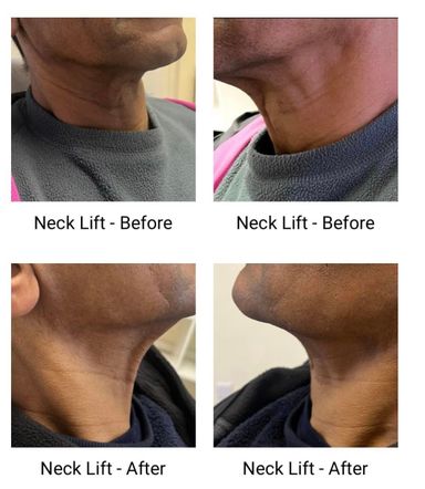 Non-Surgical Neck Lift