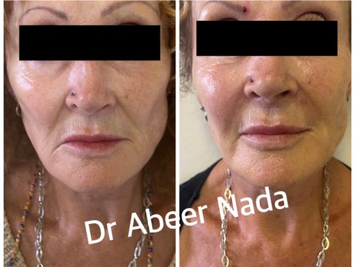 Upper lip correction and corners of mouth