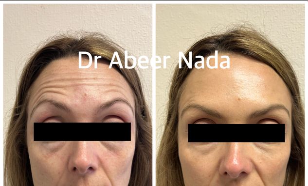 Forehead Lines Anti-wrinkle Injection