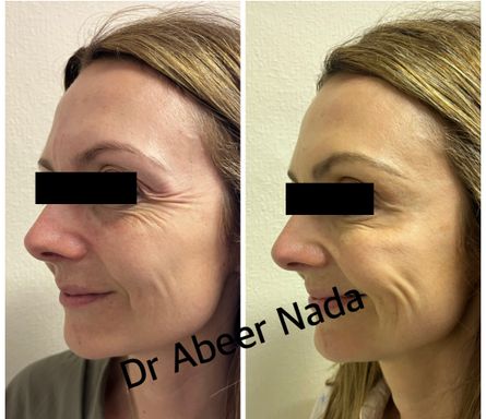 Crow's Feet Anti-Wrinkle Injection