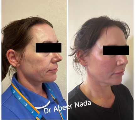 Cheek and Nose to mouth lines filler