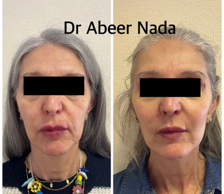 Facelift